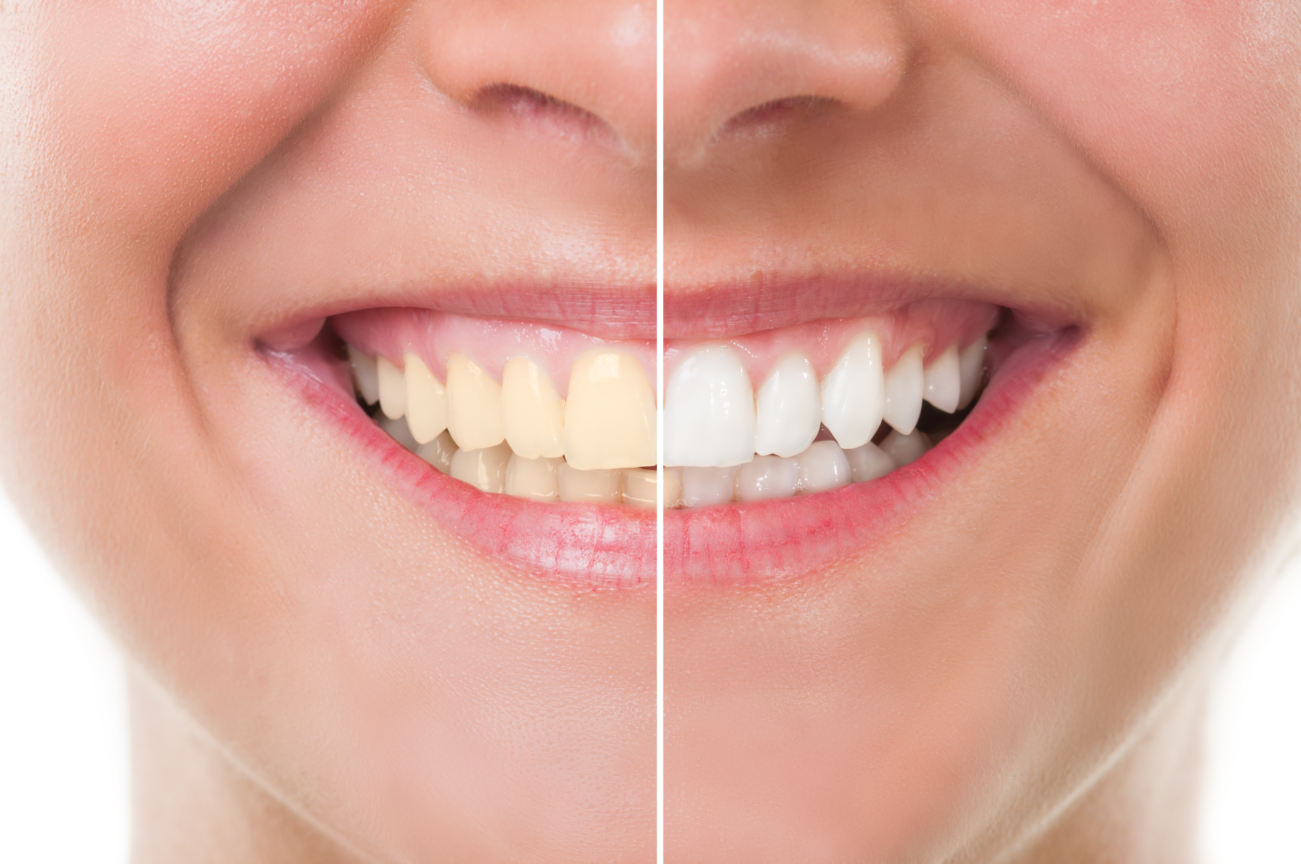 cost teeth whitening